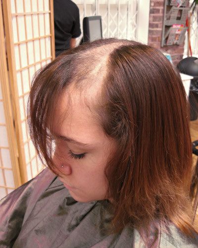 kid with bald patches